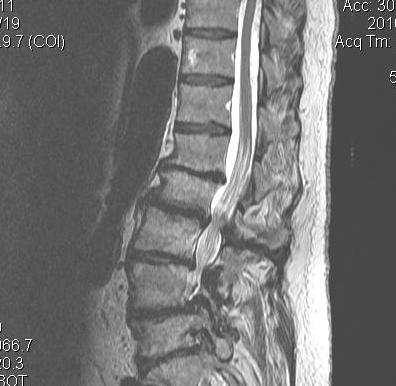 Degenerative Scoliosis MRI